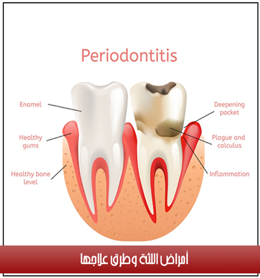 Periodontal diseases and their treatment Retaj Medical center