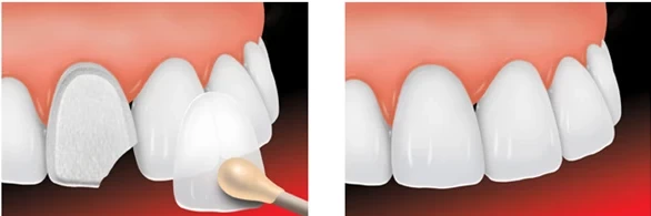 خطوات وضع فينير البورسلين 