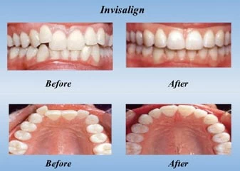 خطوات إجراء تقويم الأسنان الشفاف