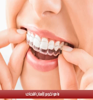 ما هو تقويم الأسنان الشفاف